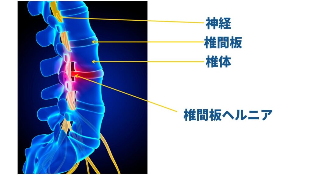 椎間板ヘルニア
