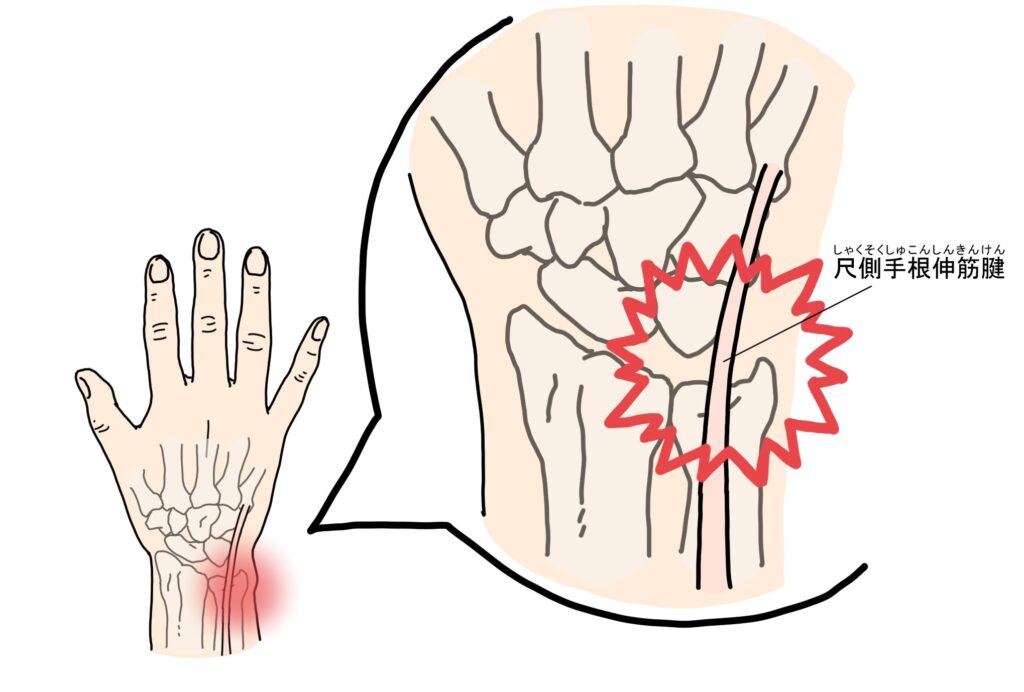 手首の小指側の痛み｜尺側手根伸筋腱炎