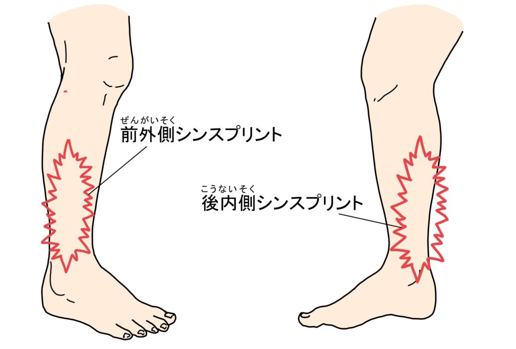 ふくらはぎの外側の痛み　シンスプリント