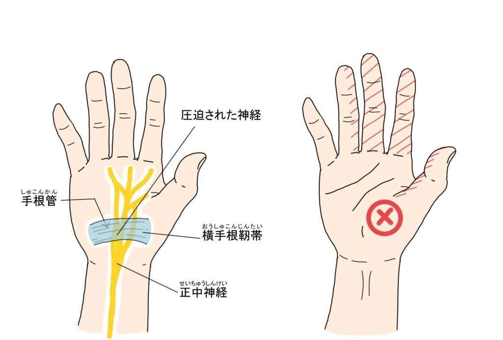 手根管症候群