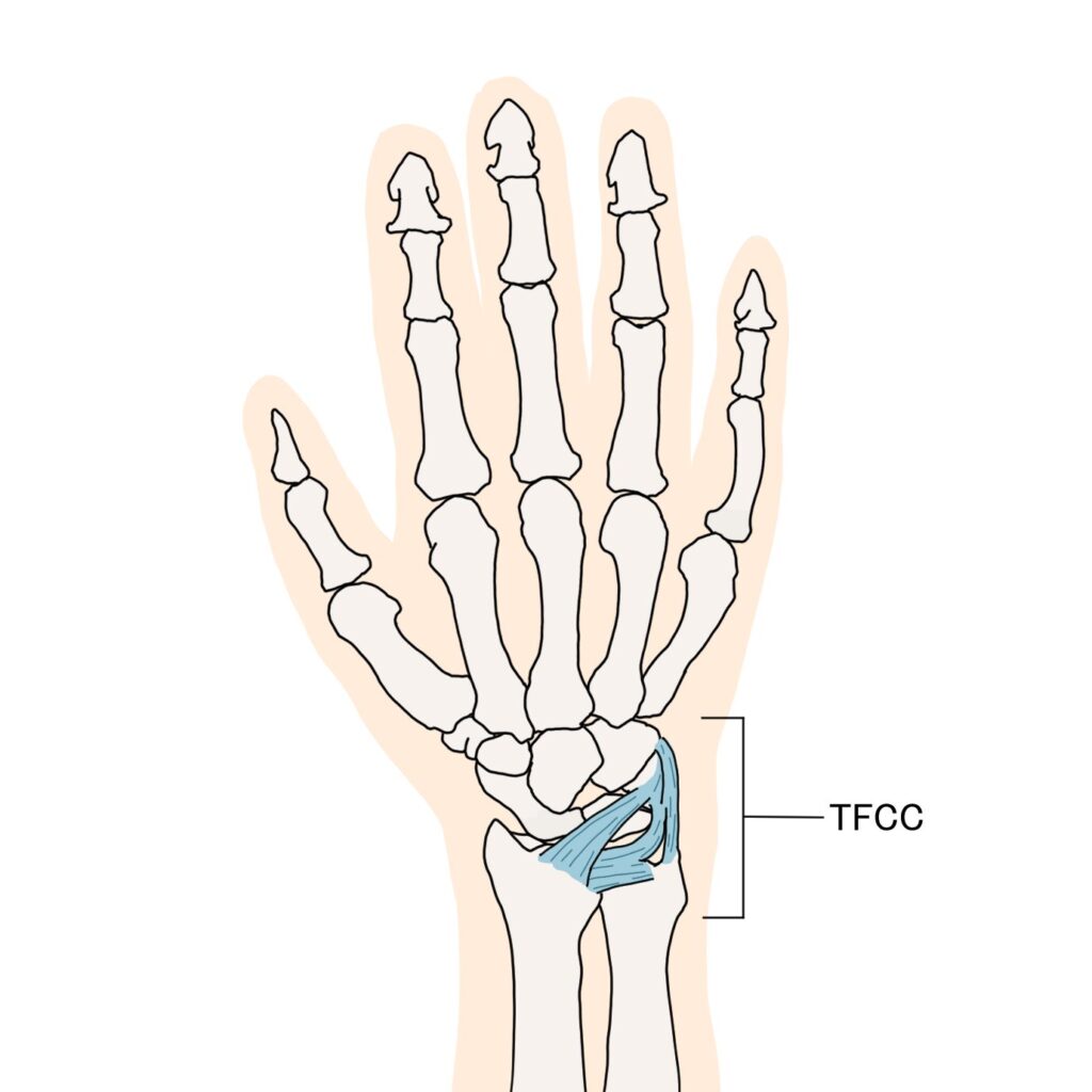 手首の小指側の痛み｜TFCC損傷