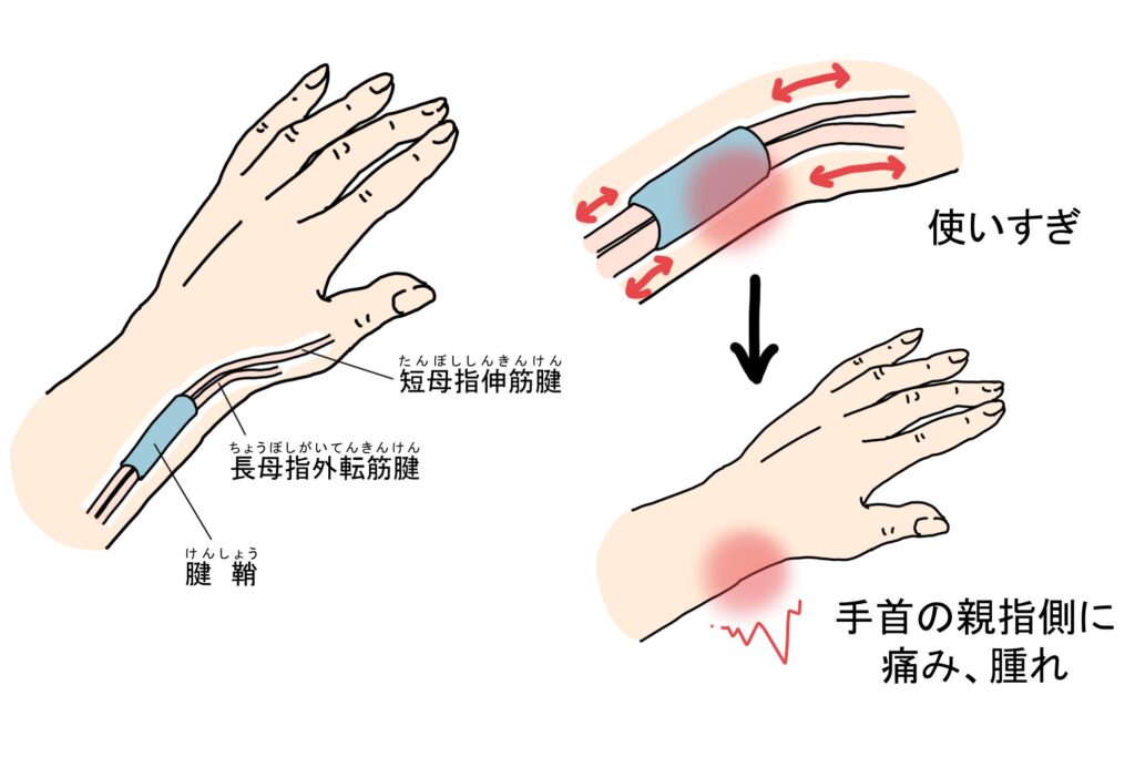 手首の小指側の痛み｜腱鞘炎