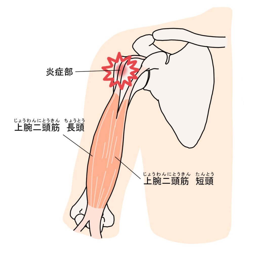 野球肩 上腕二頭筋長頭腱炎