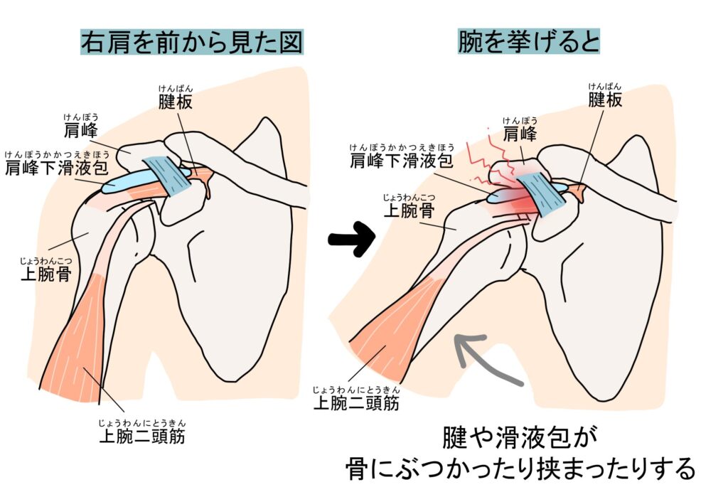 野球肩 肩峰下インピンジメント症候群 滑液包など