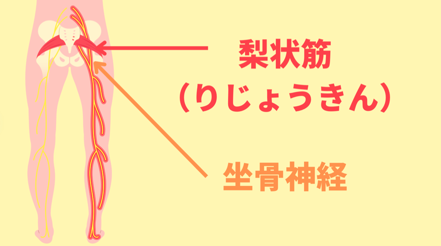 坐骨神経痛