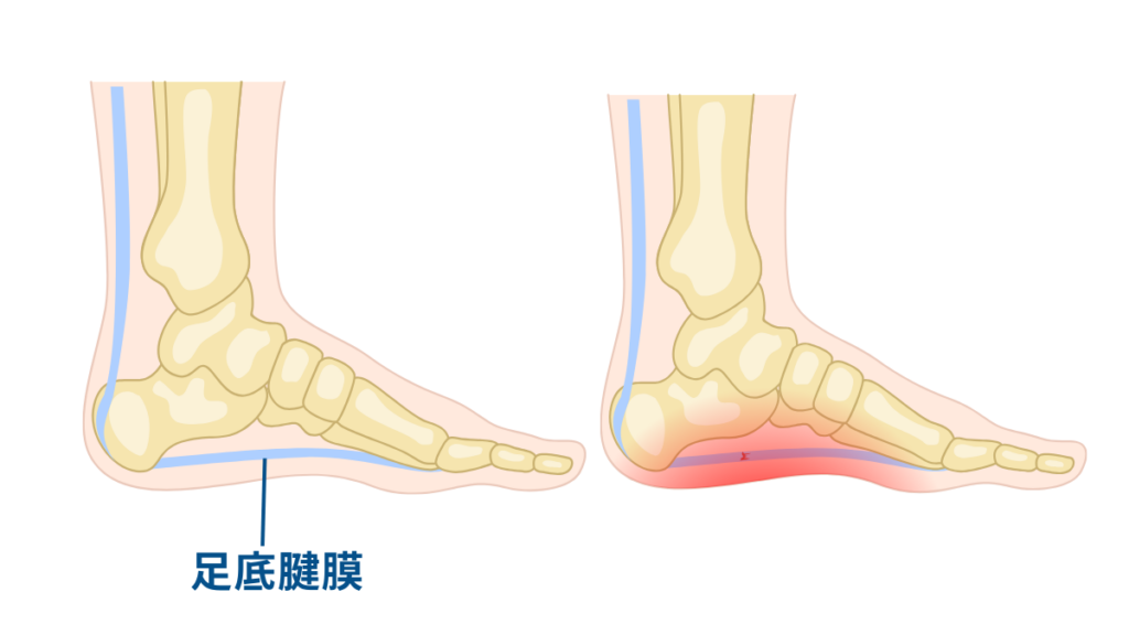 足底筋膜と足底腱膜