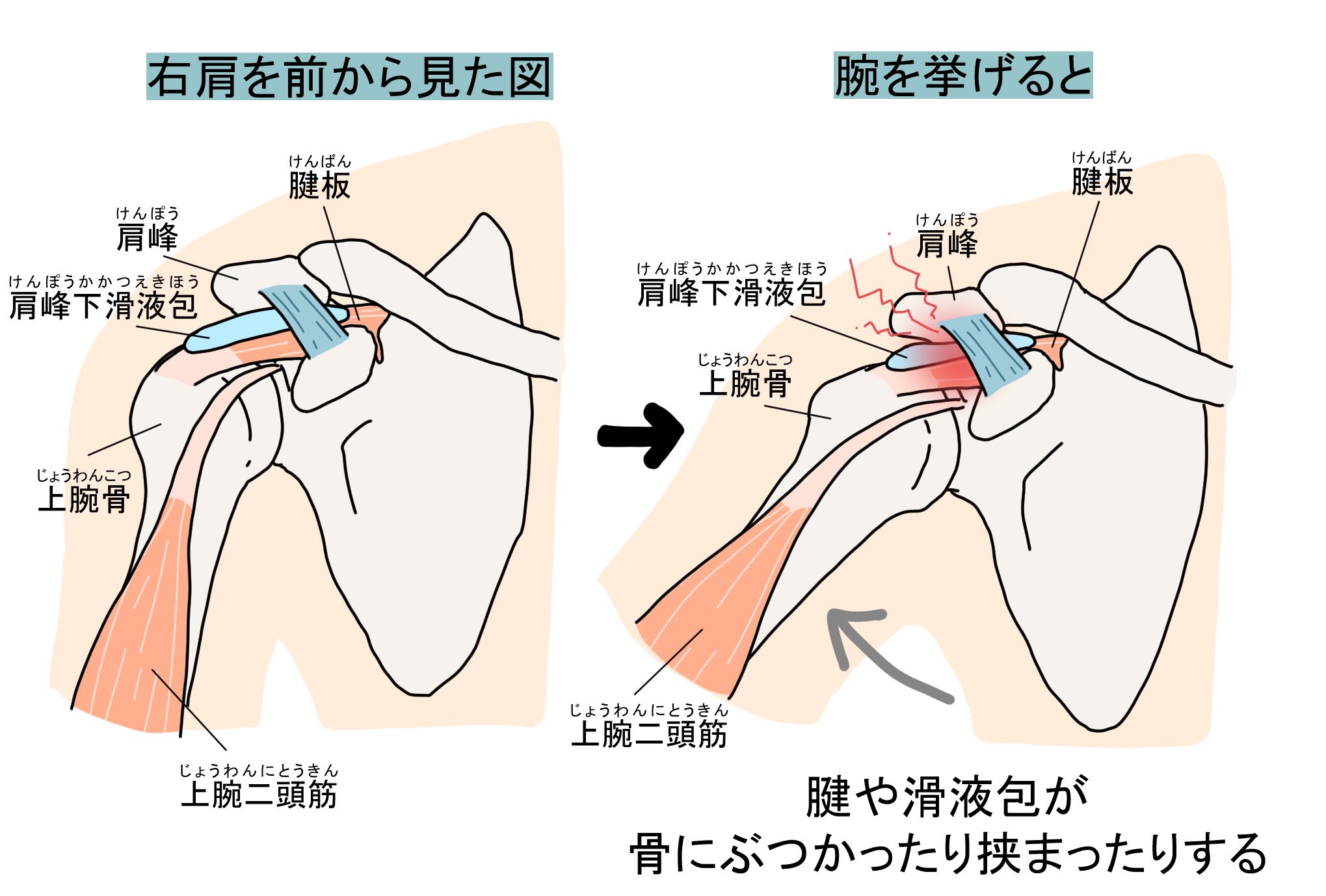 肩峰下インピンジメント症候群　滑液包など