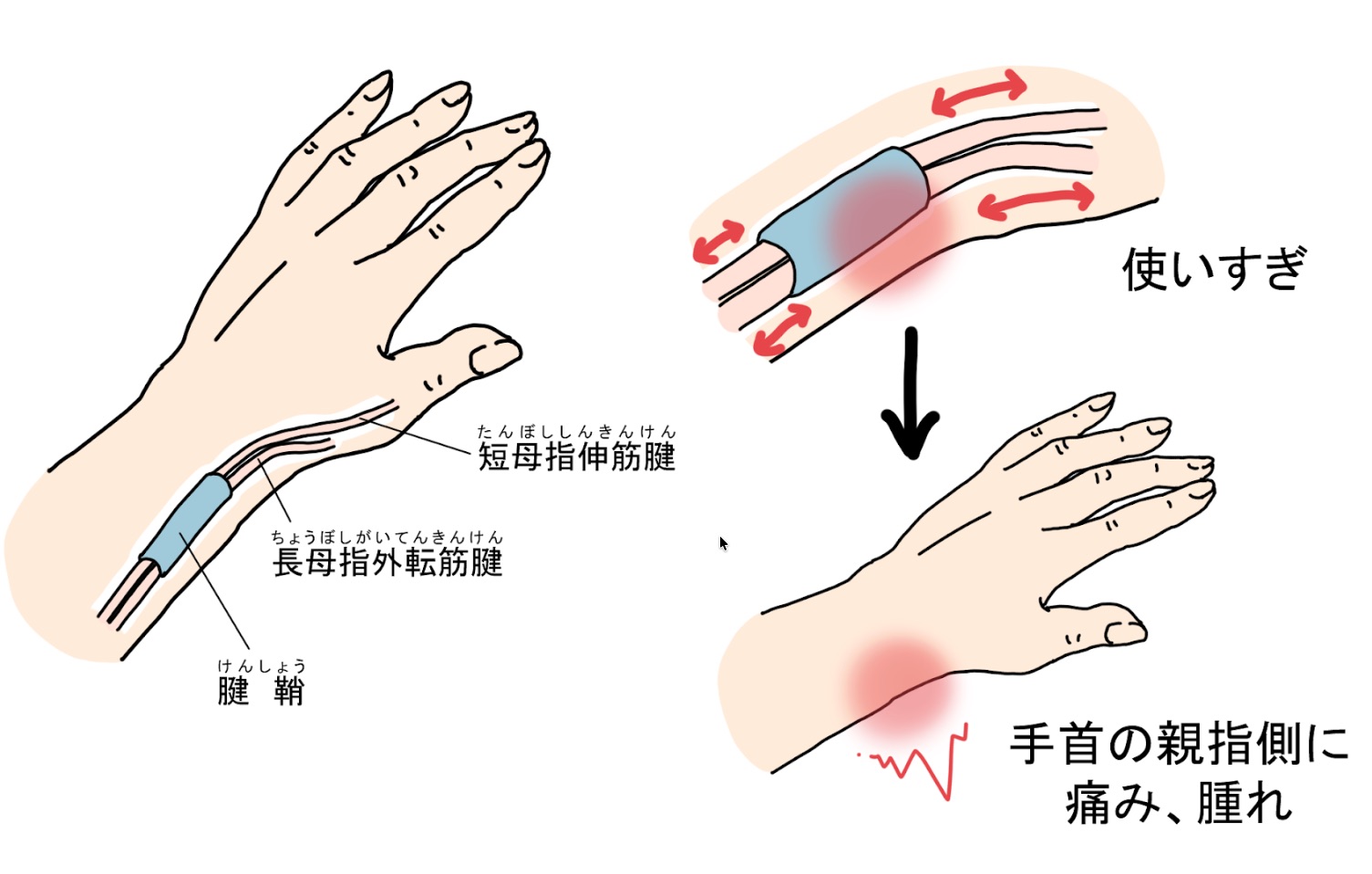 手首の親指側の痛み　腱鞘炎