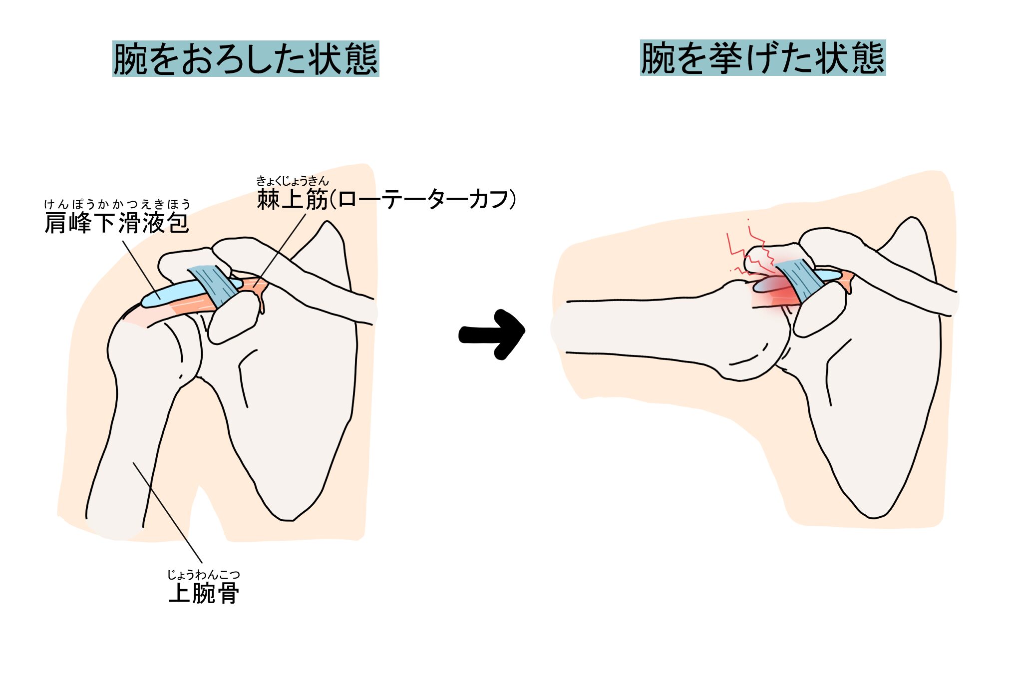 棘上筋　インピンジメント