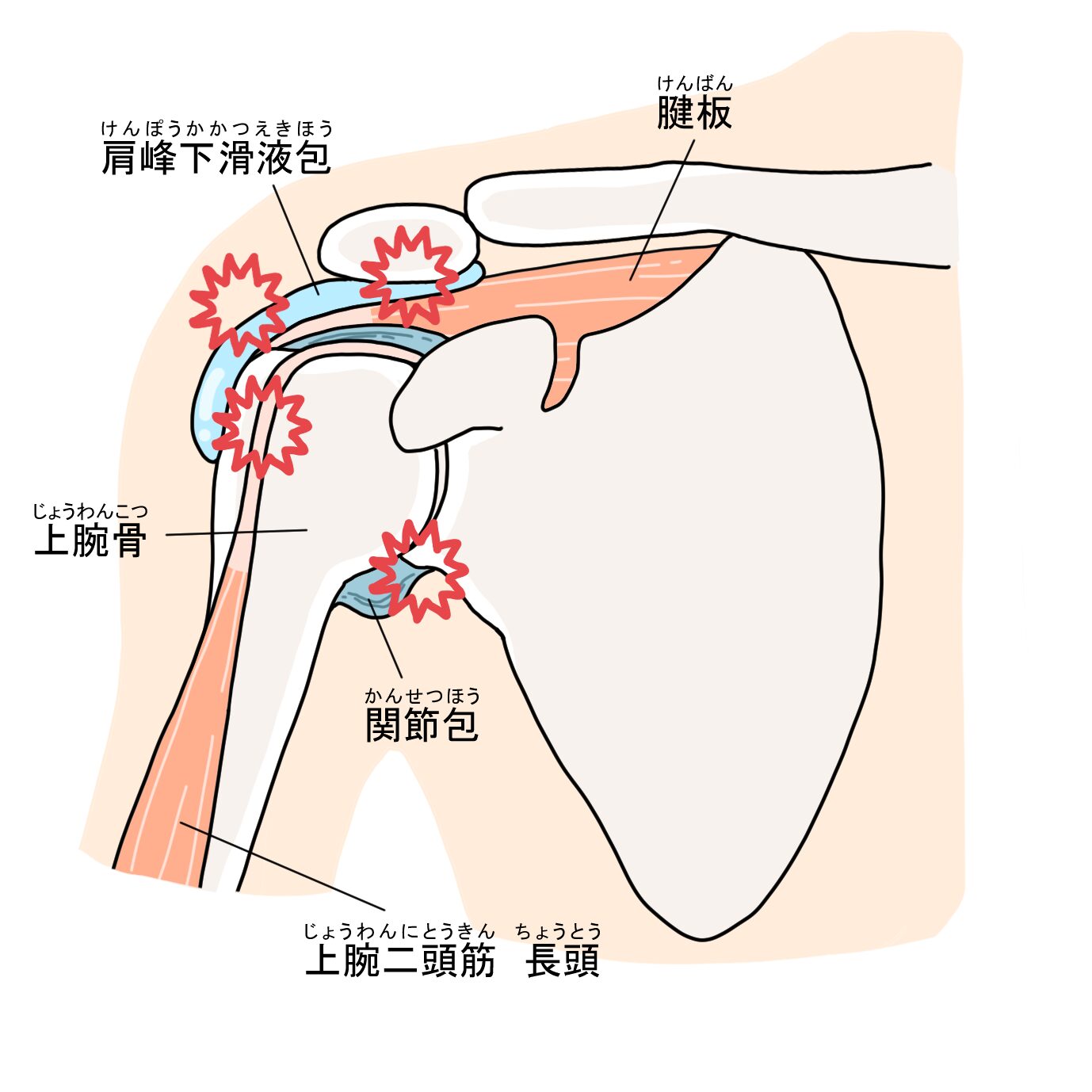 肩関節周囲炎
