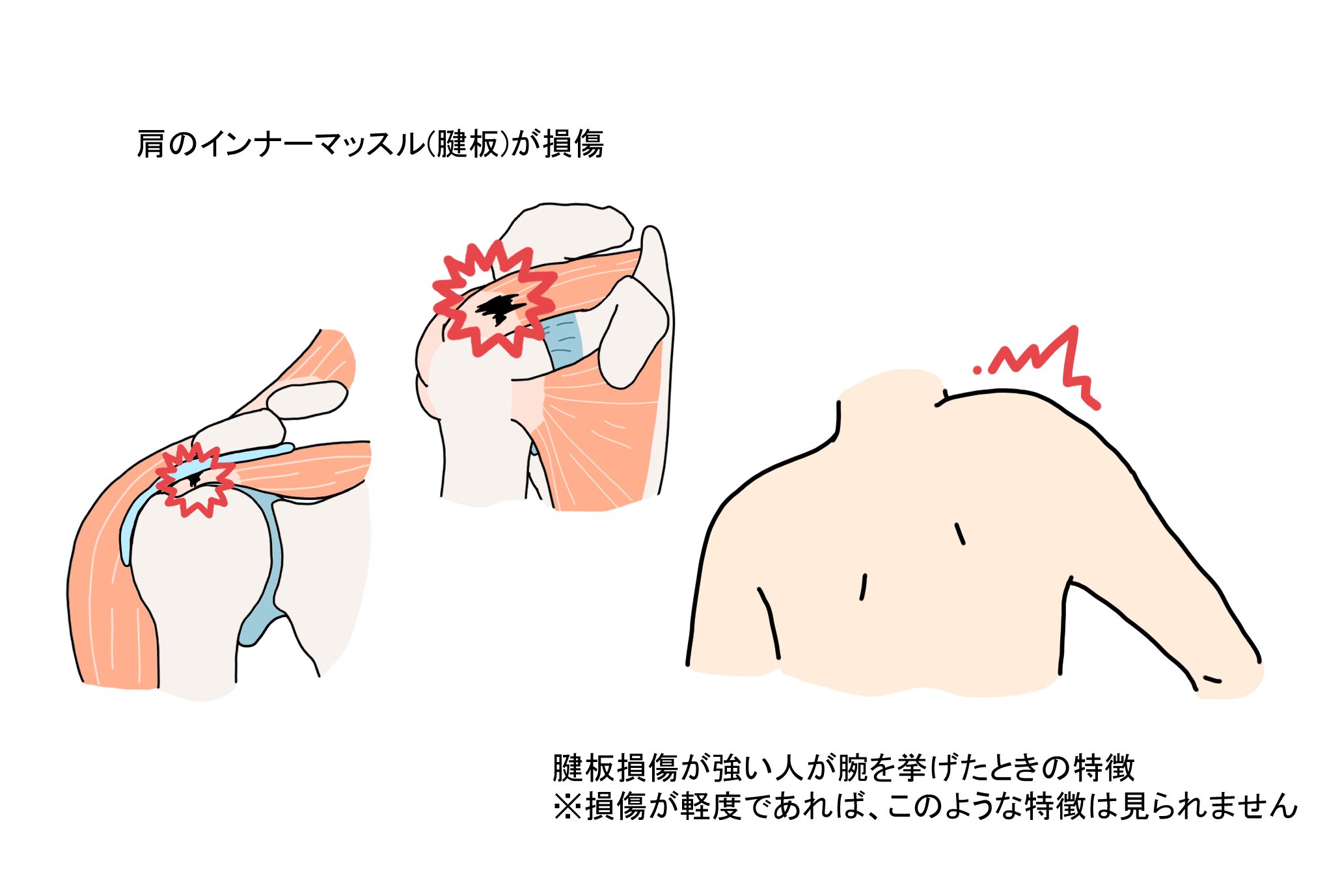 肩腱板断裂(損傷)