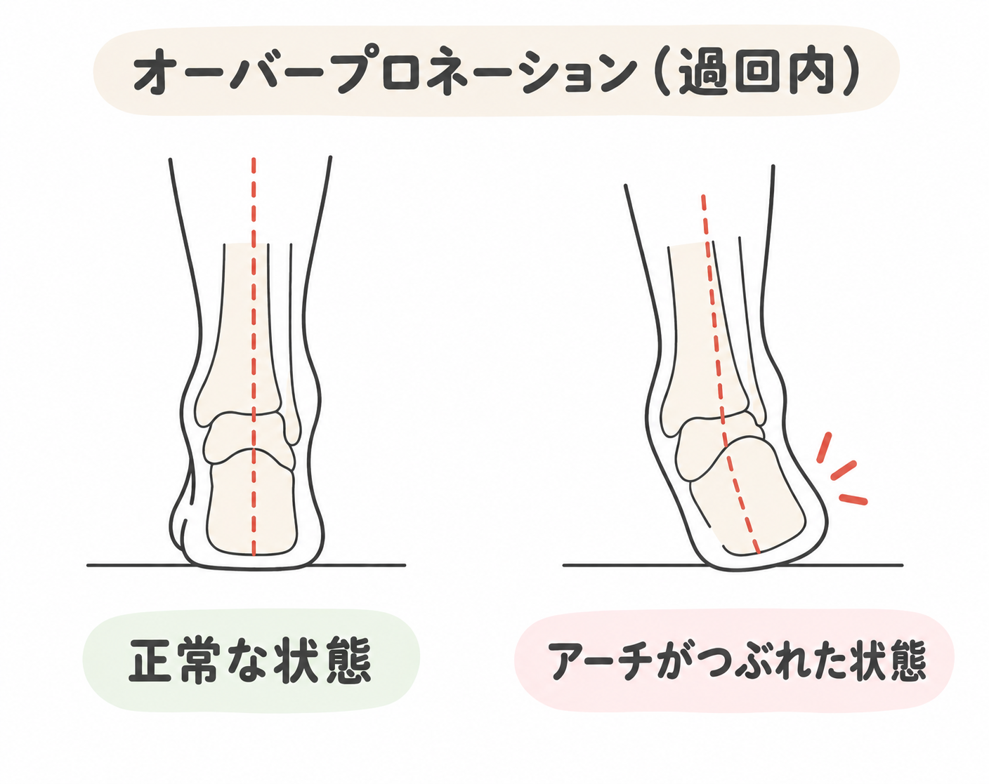 過回内（オーバープロネーション）
