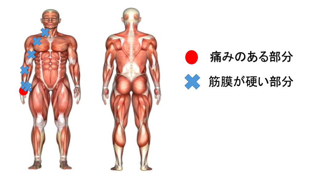 筋膜リリース　痛み